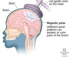 Transcranial Stimulation Concepts